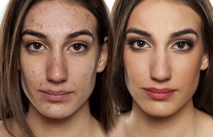 2-face comparisons can be seen with acne prone skin on the left and acne-free skin on the right.