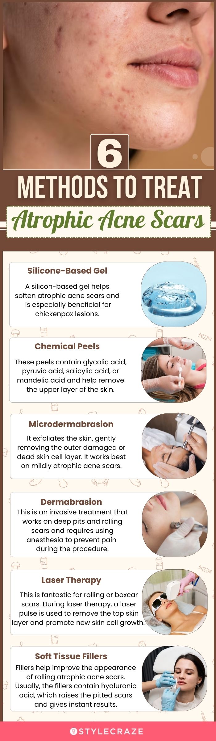 6 methods to treat atrophic acne scars (infographic)