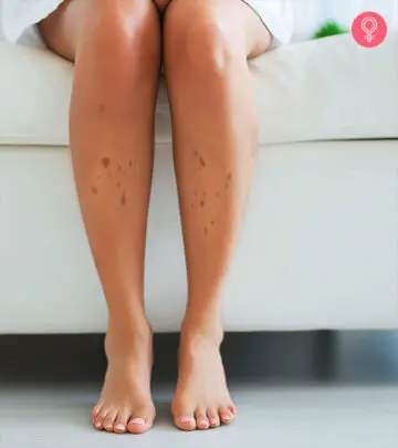 A woman with dark spots on legs