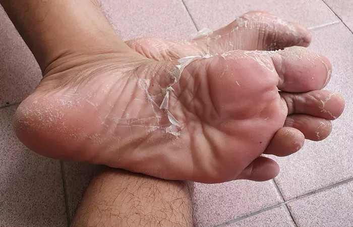 Peeling skin on feet due to aging