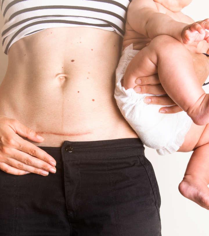 All You Need To Know About C-Section Scars