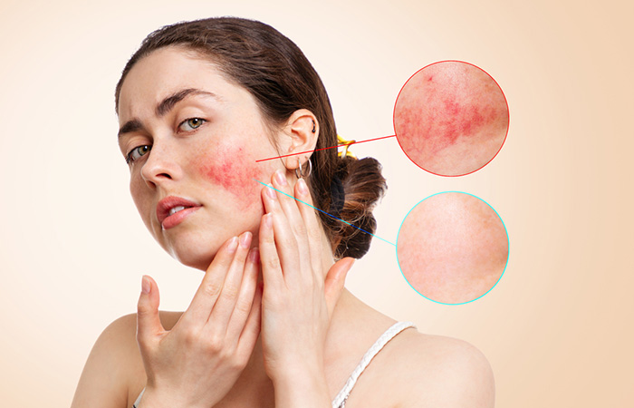 Madecassoside combate la inflamación de la piel
