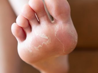 Causes And Remedies Of Peeling Skin On Feet