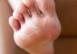 Peeling Skin On Feet: Causes, Home Remedies, And Prevention