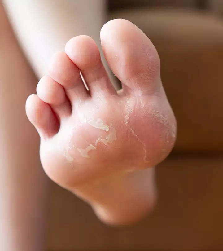 Causes And Remedies Of Peeling Skin On Feet