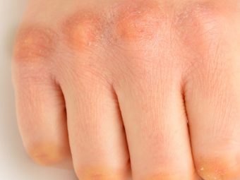 Dark Knuckles Causes And Treatment