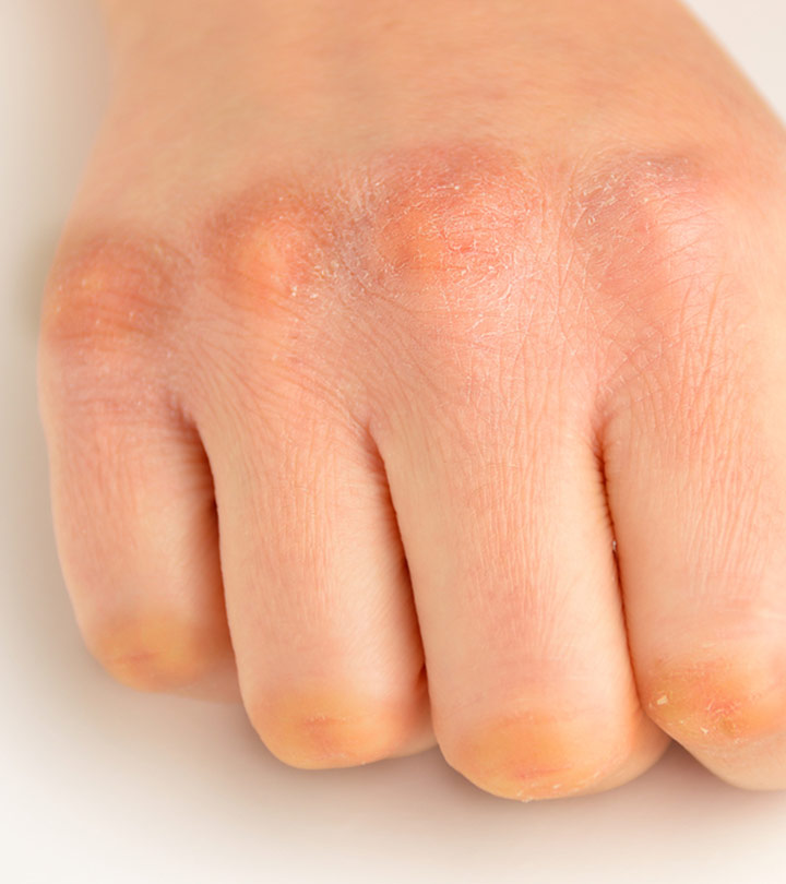 Dark Knuckles: Causes And Treatment
