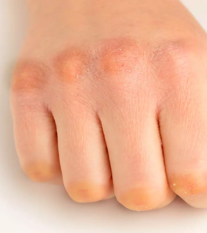 How To Get Rid Of Dark Knuckles - Skin Care