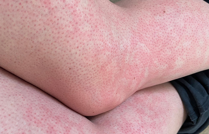 Netty patches on the skin due to heat is a sign of toasted skin