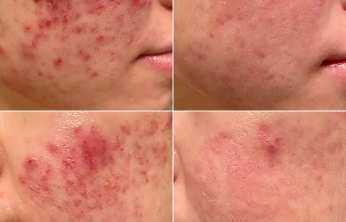 Different types of atrophic acne scars
