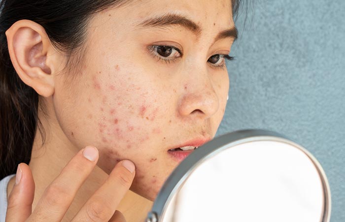 Woman experiences breakouts due to PHAs