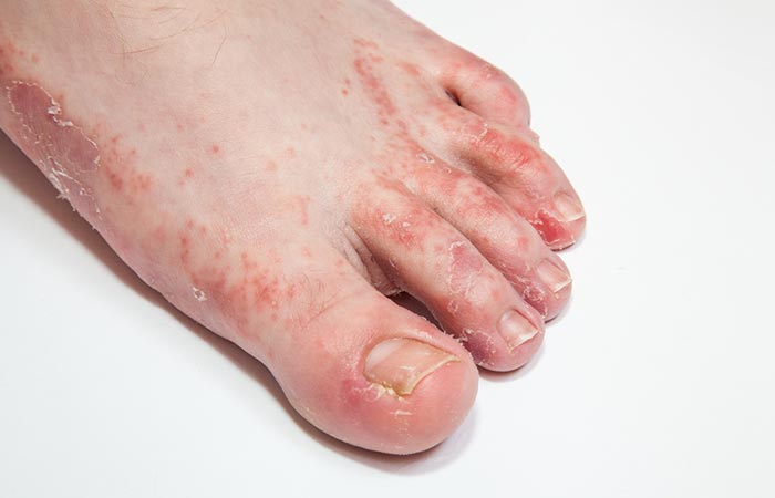 Eczema can cause peeling skin 