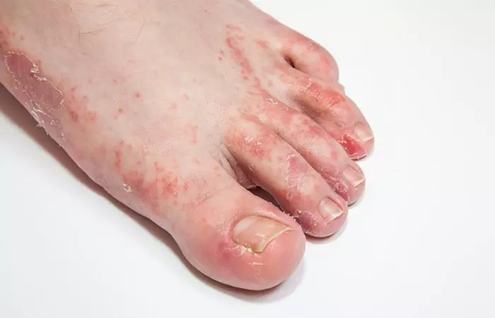 Eczema can cause peeling skin 