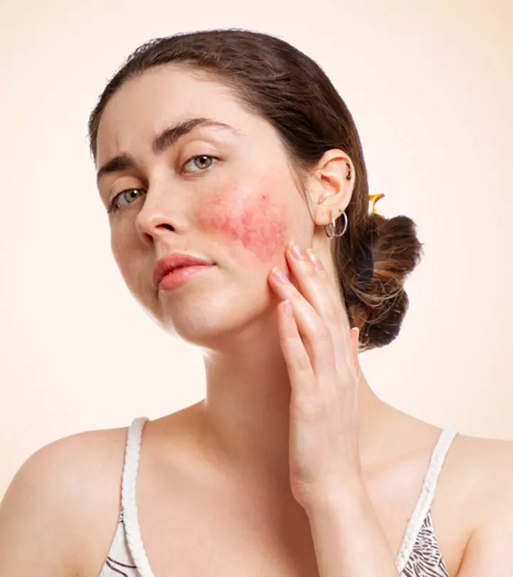 Person With A Chemical Burn On Her Hand