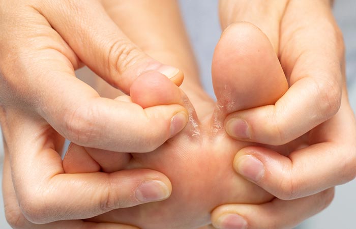 Fungal infections like athlete’s foot may cause skin peeling