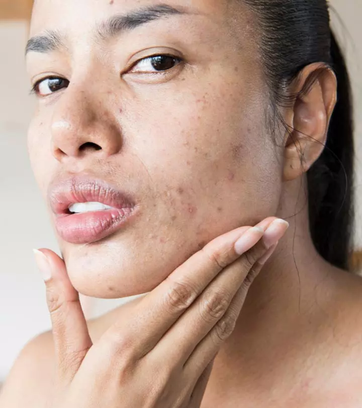 A woman with stress affected skin