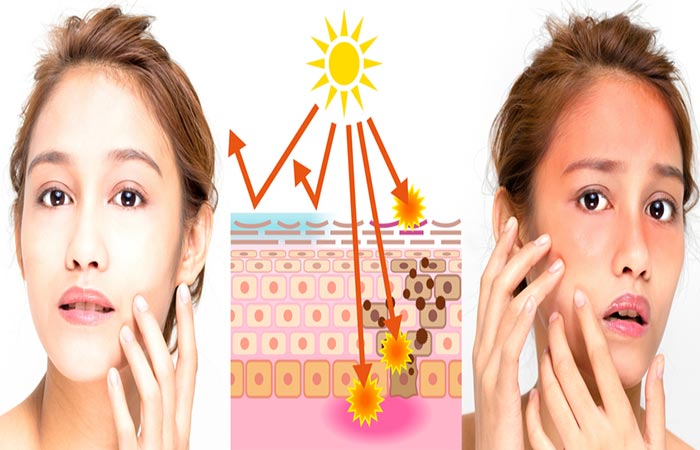 UV protected skin vs. normal skin with no UV protection to show Sun Poisoning symptoms 