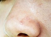 Whiteheads On Nose: Causes, Treatments, And Prevention