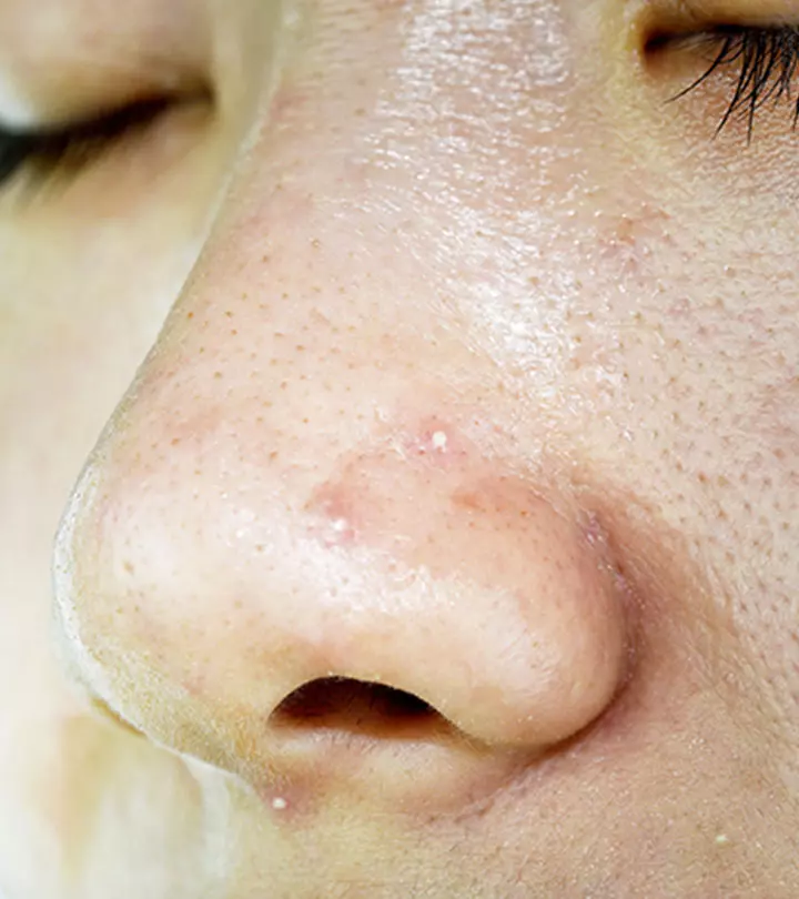 How To Get Rid Of Whiteheads On Nose: Causes And Treatment