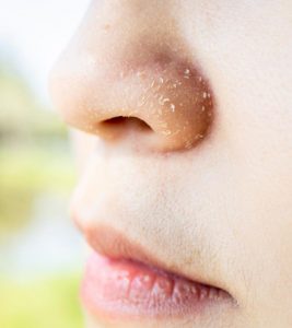 10 Remedies To Heal Dry Skin Around The N...