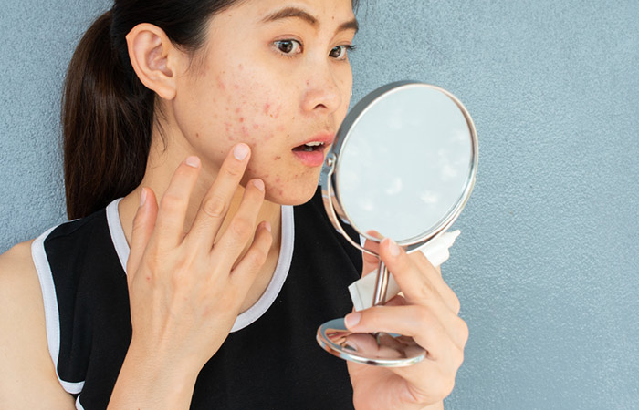 Woman trying to recognize acne papules in the mirror