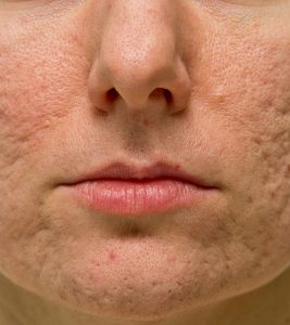 Different Types Of Atrophic Acne Scar...