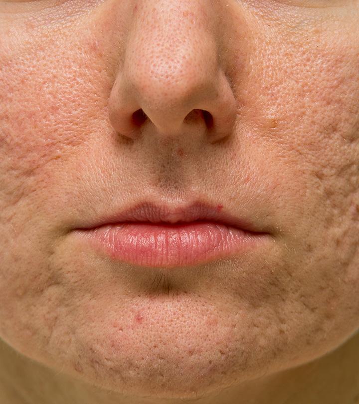 Different Types Of Atrophic Acne Scars And How To Treat Them