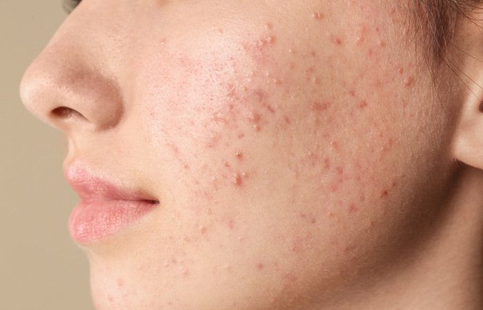 Woman with acne-prone skin should avoid methylparaben products