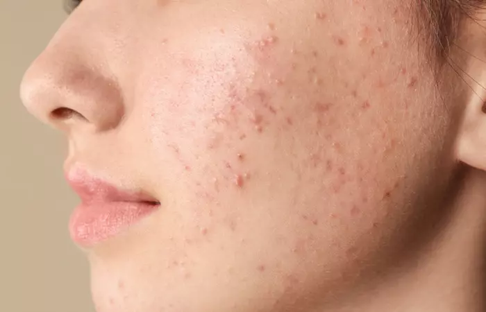 Woman with acne-prone skin should avoid methylparaben products