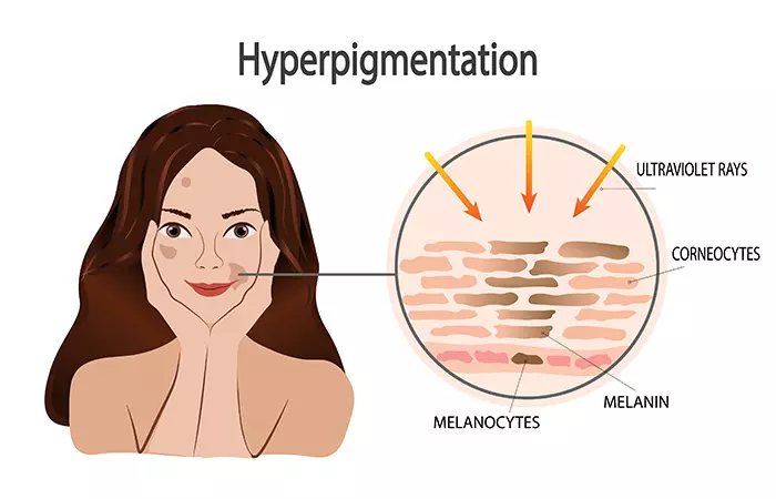 Melasma vs hyperpigmentation