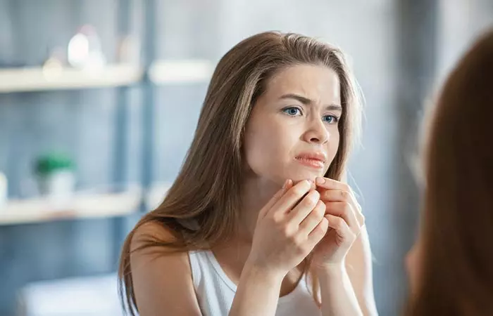 Woman with acne on the chin