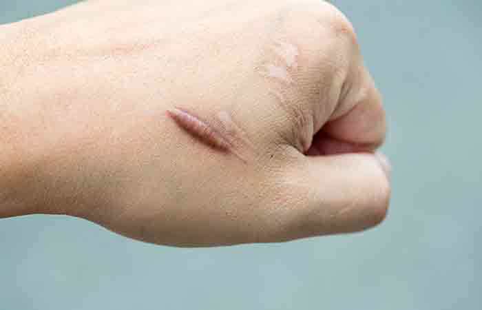 Keloid scar on hand