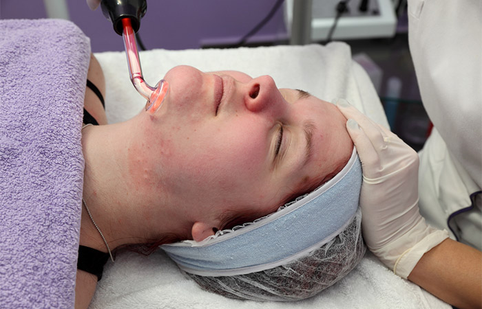 Laser therapy reduces acne scars