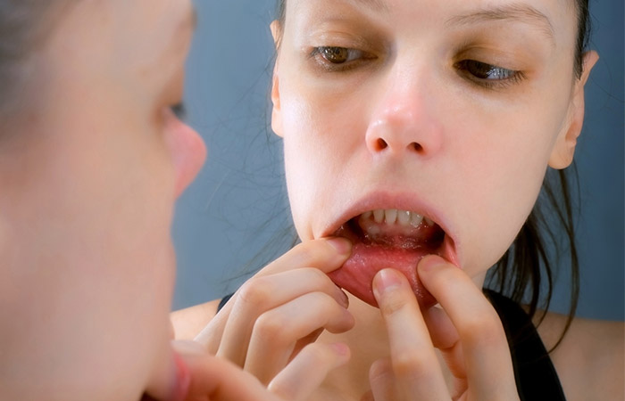 Woman looking for stomatitis as neem side effect
