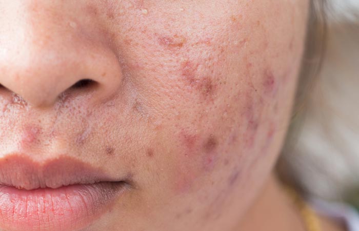 Woman with acne scars may benefit from almond oil