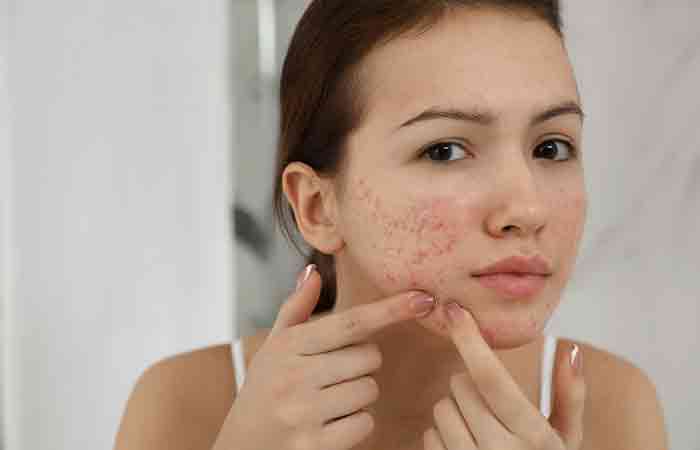 Vodka may help manage acne