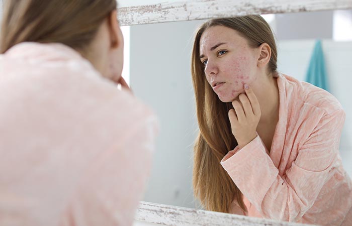 Woman with acne may benefit from almond oil