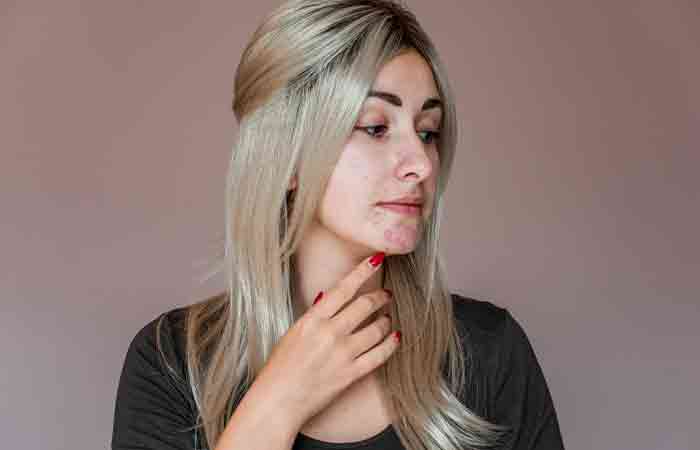 Squalane oil may treat acne-prone skin