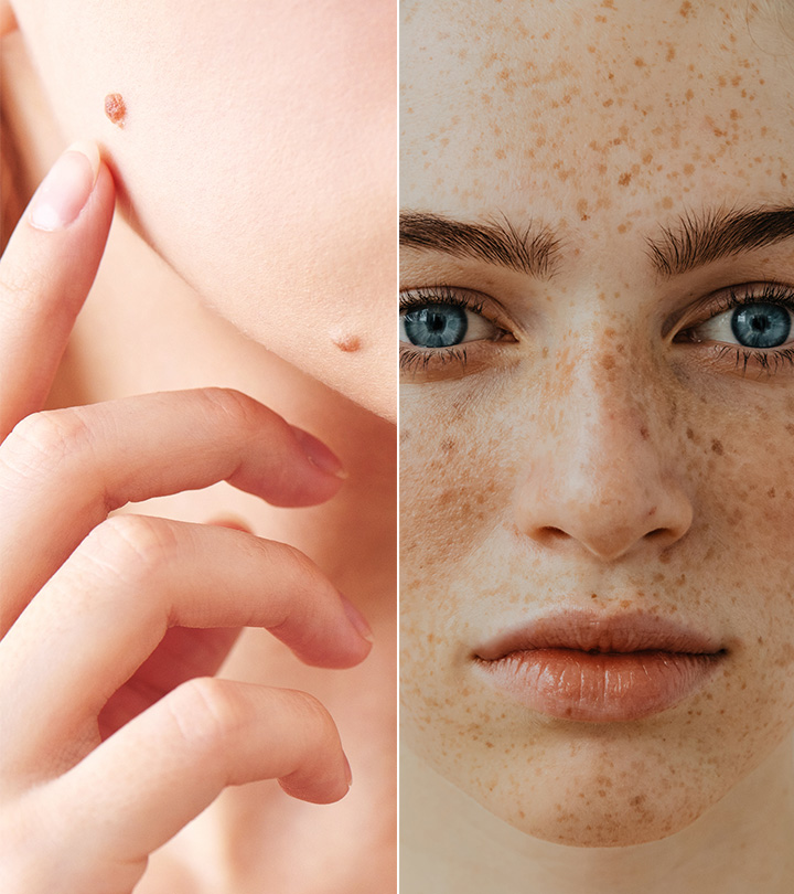 Freckle Vs. Mole: What’s The Difference And Is It Dangerous?