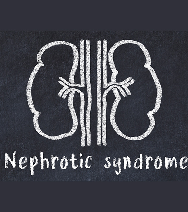 नेफ्रोटिक सिंड्रोम के कारण, लक्षण और इलाज - Nephrotic Syndrome in ...
