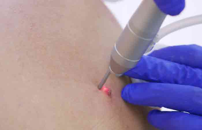 Patient undergoes a cauterization process to get rid of skin tags