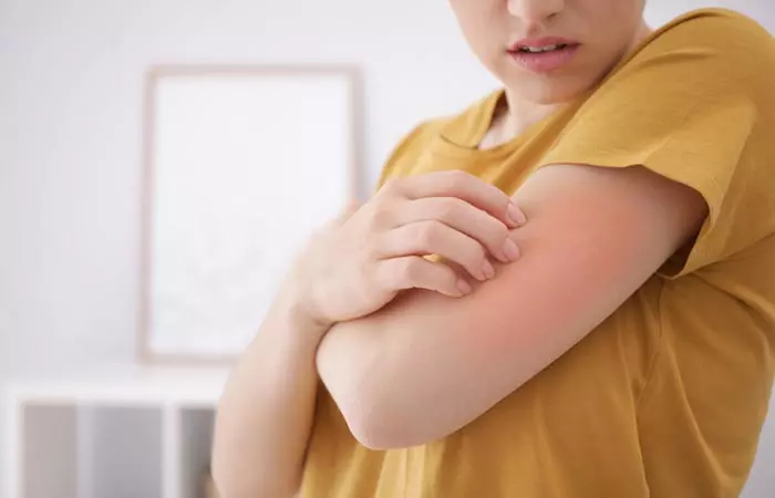 Woman experiencing redness and itchiness after applying neem oil