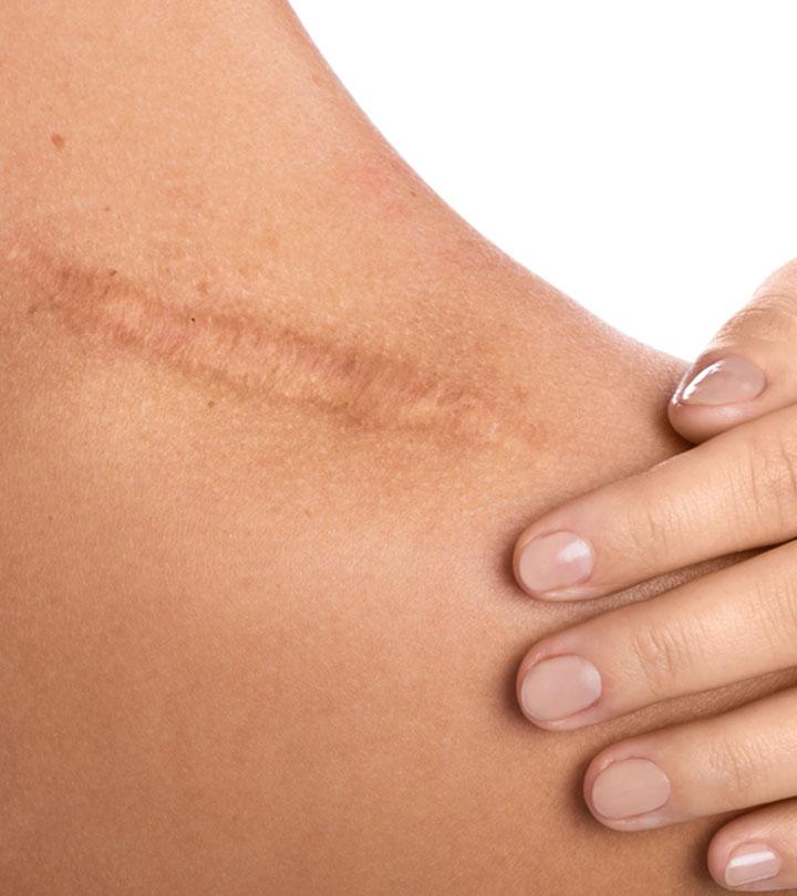 Mô sẹo: Các triệu chứng, cách điều trị và cách kiểm soát cơn đau