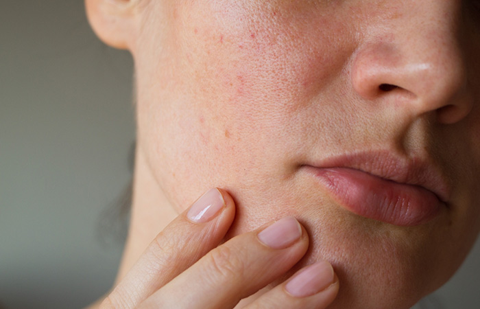 People with sensitive skin should avoid madecassoside