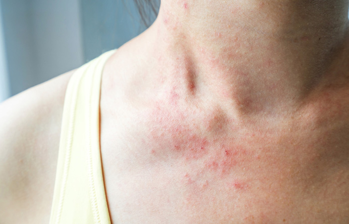 Products with methylparaben may cause rashes