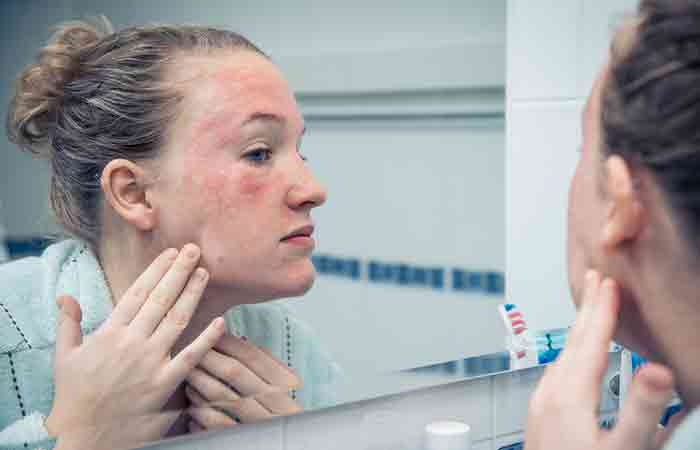 Woman experiencing allergic reactions due to side effects of phenoxyethanol