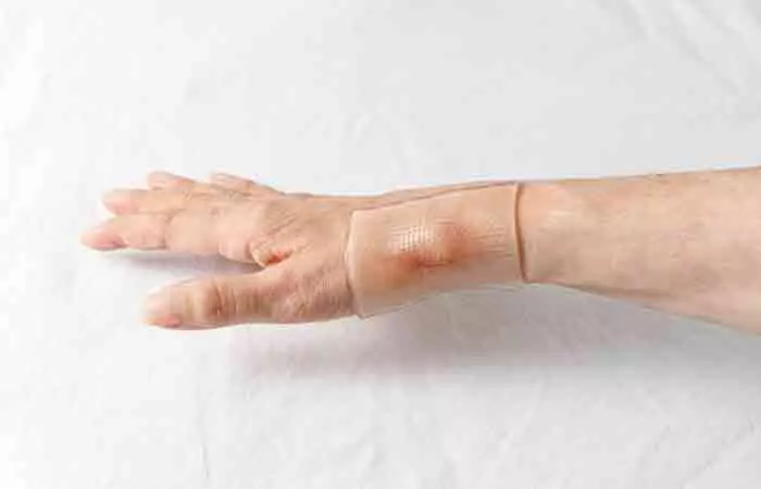 Woman wearing silicone gel patch over burn scar on her hand
