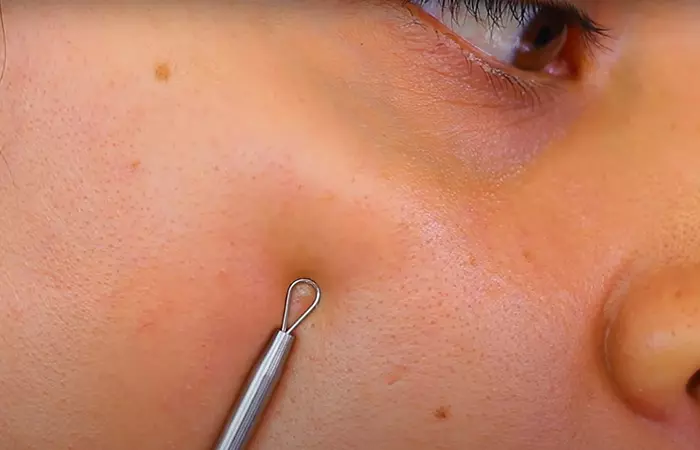 Extract the blackheads and whiteheads for facial extraction