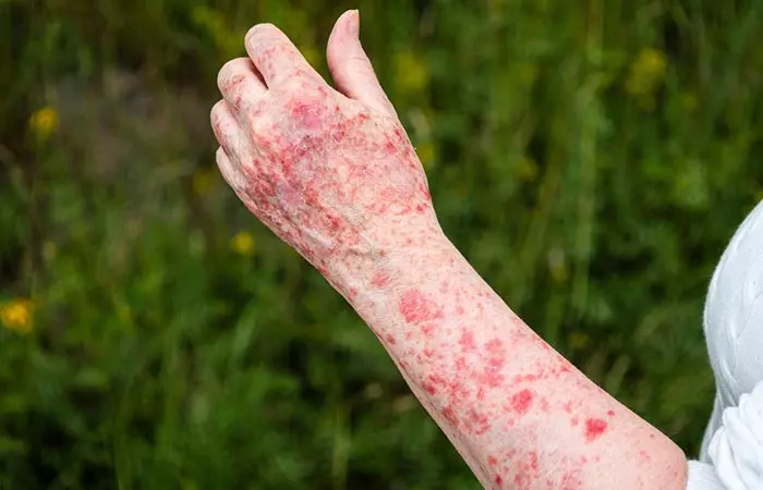 Sun poisoning shows up as an allergic reaction due to excessive sun exposure