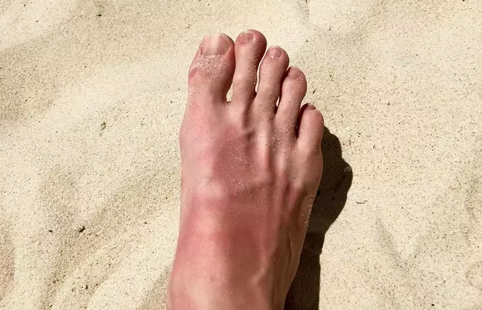 Sunburn may cause the skin on your feet to peel